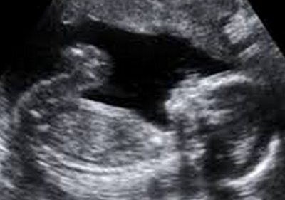 胎児死亡の診断は2度の診察で慎重に。　（画像はイメージです）