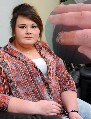 17歳少女、つけ爪接着剤により指先が壊死　（walesonline.co.ukのスクリーンショット）
