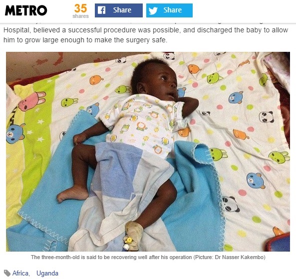 ウガンダで「寄生性双生児」の手術が成功（画像はmetro.co.ukのスクリーンショット）