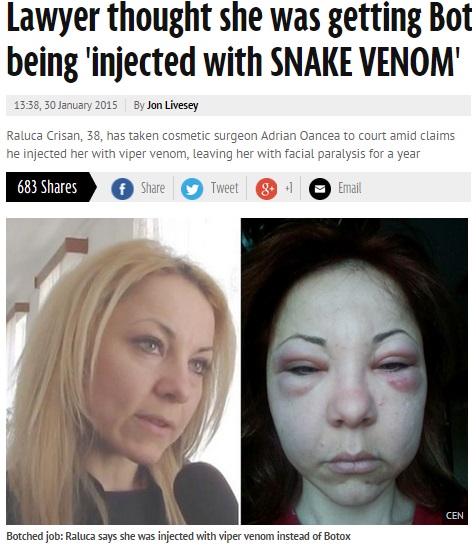 ヘビ毒による「偽ボトックス」被害にあった女性（画像はmirror.co.ukのスクリーンショット）
