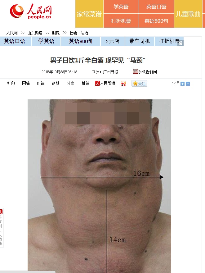 【海外発！Breaking News】顔に巨大な腫瘍が。1日1升の酒が災いして（中国）