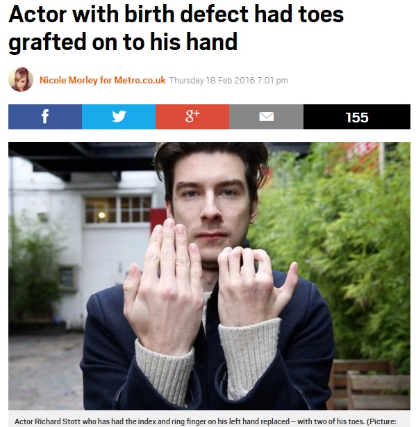「僕は先天性の奇形には負けない」と英28歳俳優（出典：http://metro.co.uk）