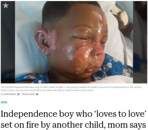 顔が焼けただれてしまったジュリアン君（画像は『The Kansas City Star　2018年8月10日付「Independence boy who ‘loves to love’ set on fire by another child, mom says」』のスクリーンショット）
