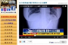 【アジア発！Breaking News】咳と胃痛に悩まされていた女性。原因は胃の中の万年筆だった！（台湾）