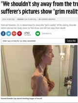 【海外発！Breaking News】18歳で洋服は10歳サイズ、激ヤセした女性が拒食症の恐怖を語る　自らの写真を公開（英）