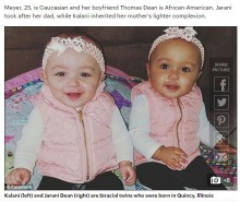 【海外発！Breaking News】500分の1の確率！　白人と黒人カップルから生まれた肌の色が違う双子の赤ちゃん（米）