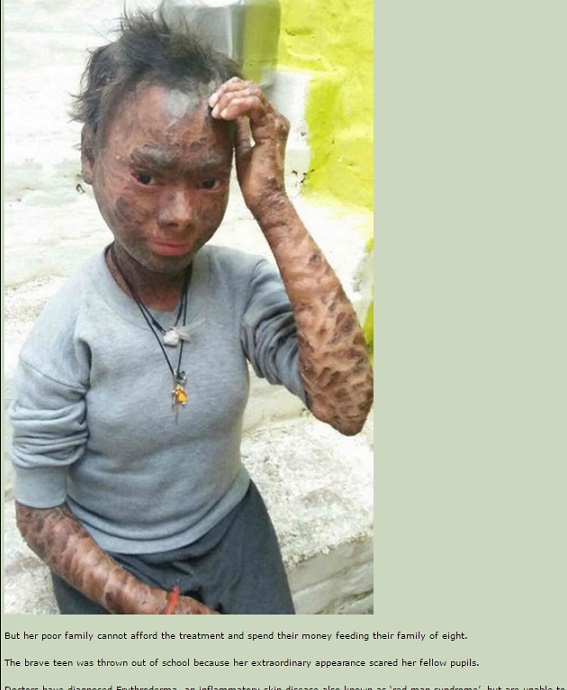 重度の紅皮症と闘う少女が「助けて下さい」と悲痛な叫び（出典：http://www.nairaland.com）