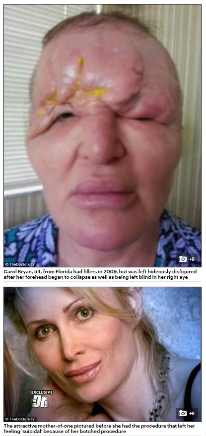 手術で顔面が腫れあがり片目を失明した女性（出典：http://www.dailymail.co.uk）