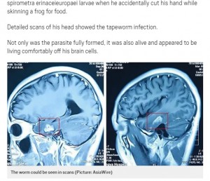 【海外発！Breaking News】脳から11cmの寄生虫を摘出　19歳男性、激しい頭痛で判明（中国）