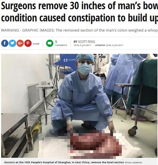 約76cmもの腸を摘出（画像は『Mirror Online　2017年6月9日付「Surgeons remove 30 inches of man’s bowel after rare condition caused constipation to build up over 22 years」（Photo: AsiaWire）』のスクリーンショット　画像を一部加工しています）