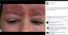 【海外発！Breaking News】眉タトゥーをした女性、眉の皮膚が剥離し爛れる事態に（豪）