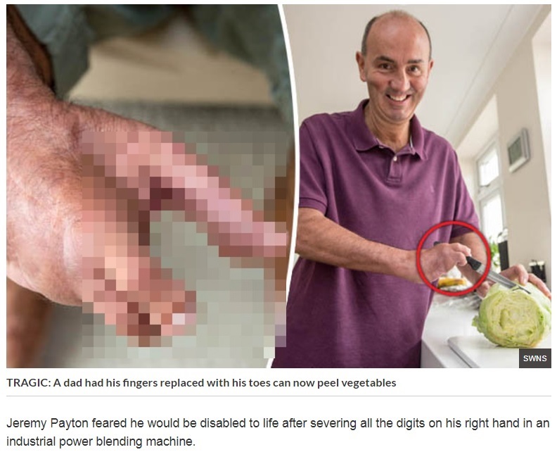 手の指を失い、足の指を移植した男性（画像は『Daily Star　2017年9月5日付「GRAPHIC: Dad has fingers replaced with toes after HORROR accident – but can peel veg now」（SWNS）』のスクリーンショット　画像を一部加工しています）