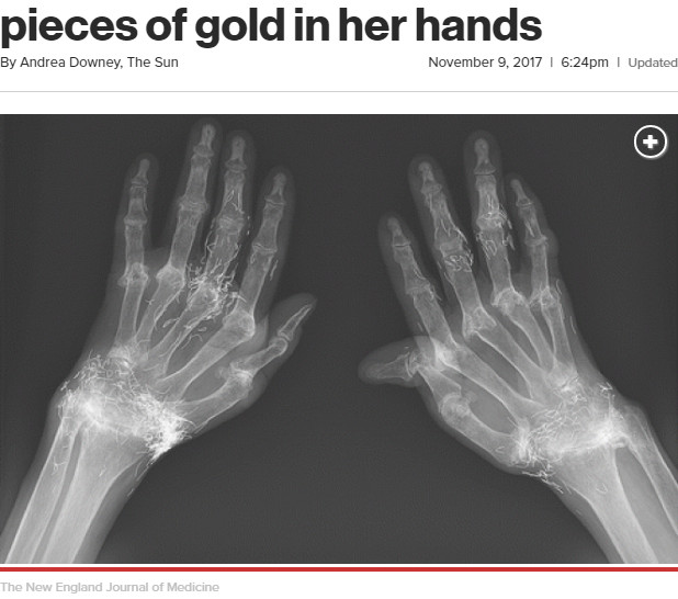 金の針が無数に埋め込まれたレントゲン写真（画像は『New York Post　2017年11月9日付「Bizarre X-ray shows woman has pieces of gold in her hands」（The New England Journal of Medicine）』のスクリーンショット）