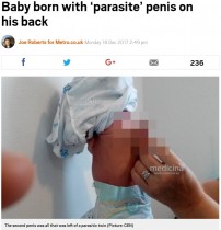 【海外発！Breaking News】背中に陰茎を持つ乳児、除去手術が無事成功（アゼルバイジャン）