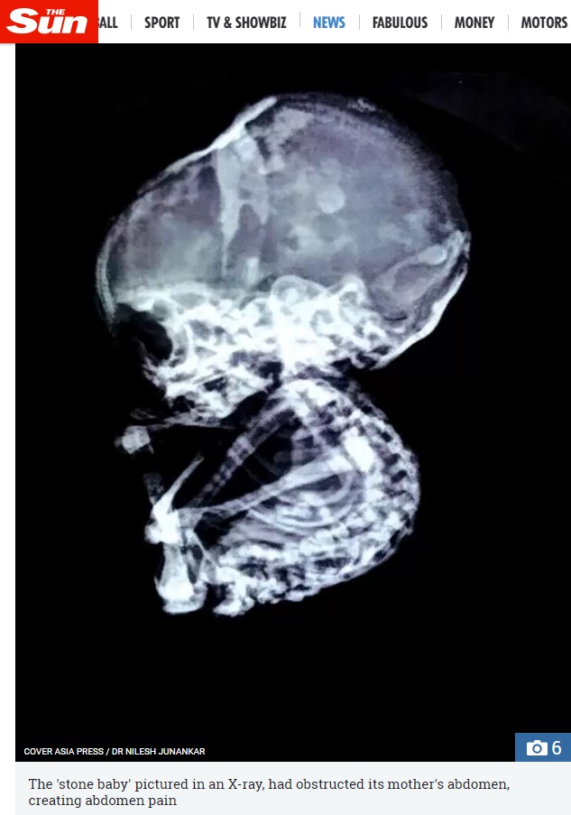 15年間、母親の胎内にいた胎児（画像は『The Sun　2017年11月30日付「BABY SHOCK Doctors discover four-month-old ‘stone baby’ inside woman who thought she aborted 15 YEARS ago」（IMAGE: COVER ASIA PRESS / DR NILESH JUNANKAR）』のスクリーンショット）