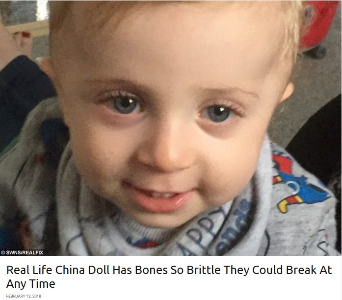 15,000人に1人の骨が脆い先天性疾患を抱える男児（画像は『real fix　2018年2月12日付「Real Life China Doll Has Bones So Brittle They Could Break At Any Time」（SWNS/REALFIX）』のスクリーンショット）