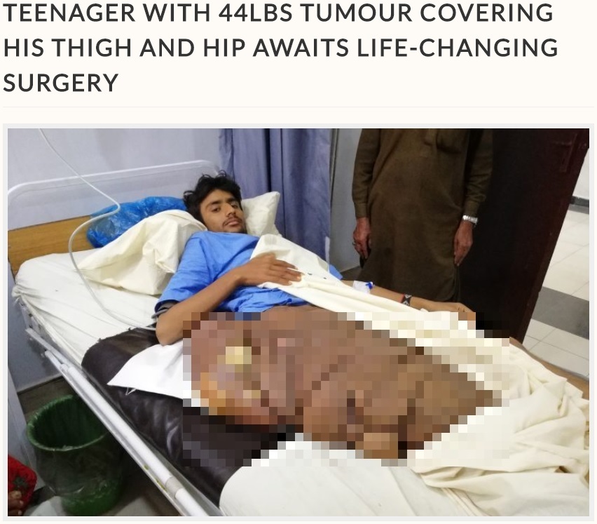 腰と大腿部に腫瘍を抱える18歳男性（画像は『Storytrender　2018年3月26日付「TEENAGER WITH 44LBS TUMOUR COVERING HIS THIGH AND HIP AWAITS LIFE-CHANGING SURGERY」（By Bilal Kuchay）』のスクリーンショット　画像を一部加工しています）