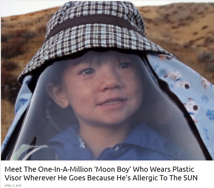 日光アレルギーを患う7歳男児（画像は『real fix　2018年4月11日付「Meet The One-In-A-Million ‘Moon Boy’ Who Wears Plastic Visor Wherever He Goes Because He’s Allergic To The SUN」（SWNS/REALFIX）』のスクリーンショット）