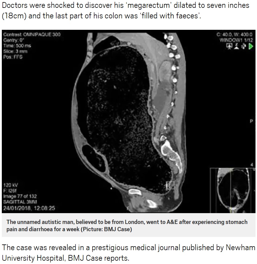 便秘が続いた男性、命の危機に（画像は『Metro　2018年8月22日付「Man had such bad constipation his bowels burst causing his organs to shut down」（Picture: BMJ Case）』のスクリーンショット）