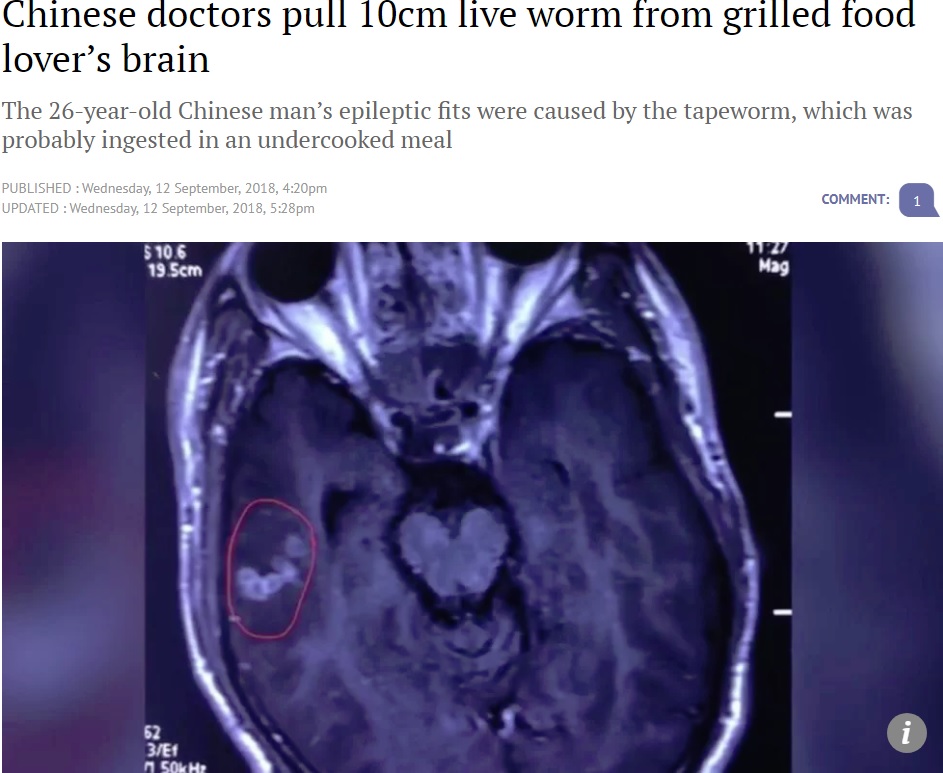 脳内で生きて発見された条虫（画像は『South China Morning Post　2018年9月12日付「Chinese doctors pull 10cm live worm from grilled food lover’s brain」（Photo: Pear Video）』のスクリーンショット）