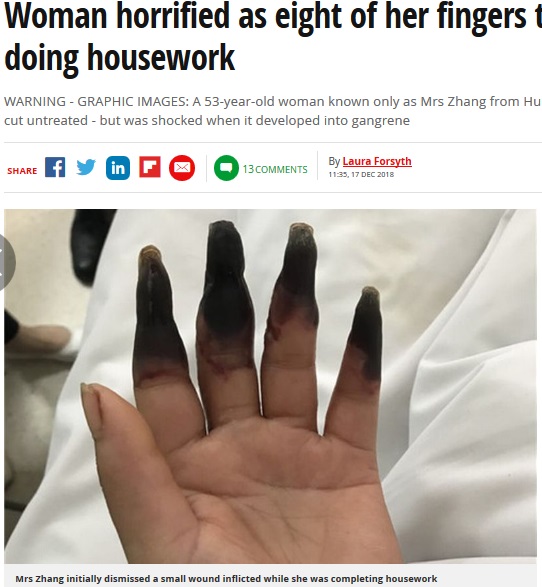 切り傷から手指が壊疽した中国人女性（画像は『Mirror　2018年12月17日付「Woman horrified as eight of her fingers turn black after doing housework」』のスクリーンショット）