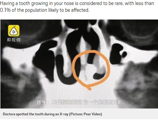 鼻の奥に生えた歯（画像は『Metro　2019年11月11日付「Man’s blocked nose was caused by tooth growing in his nostril（Picture: Pear Video）』のスクリーンショット）