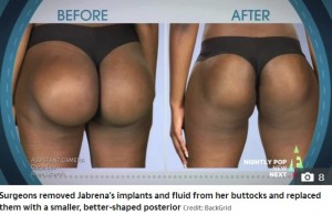 インプラントを入れた状態と再手術後のジャブリナさんの臀部（画像は『The Sun　2019年12月3日付「ROCK BOTTOM Woman left in agony after botched bum implants ROTATED inside her」（Credit: BackGrid）』のスクリーンショット）