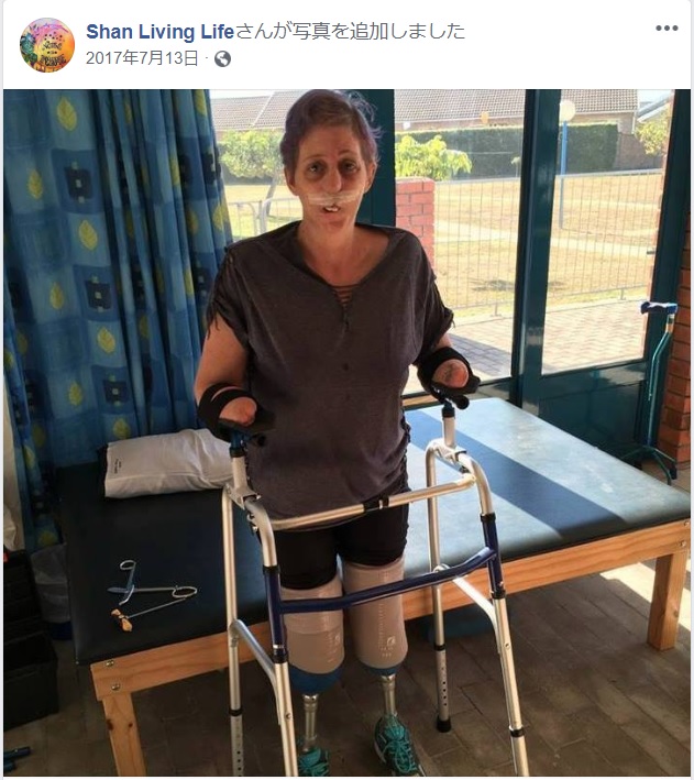 壊死した手脚を切断せざるを得なかった女性（画像は『Shan Living Life　2017年7月13日付Facebook』のスクリーンショット）