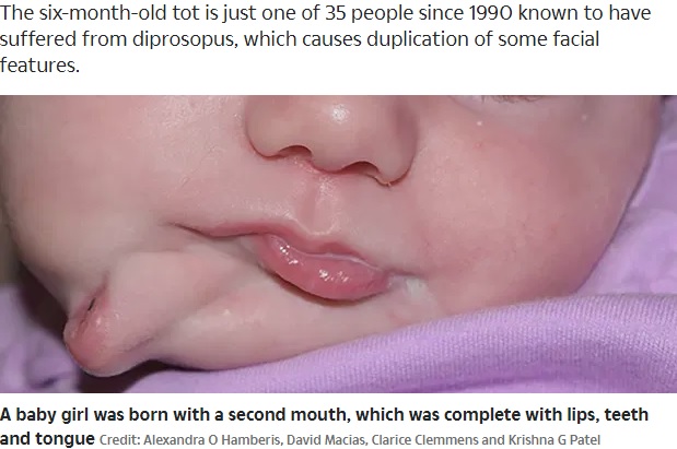 2つの口を持って生まれた赤ちゃん（画像は『The Sun　2020年5月29日付「DEFIED THE ODDS Baby girl has SECOND mouth complete with lips, teeth and tongue removed in op」（Credit: Alexandra O Hamberis, David Macias, Clarice Clemmens and Krishna G Patel）』のスクリーンショット）