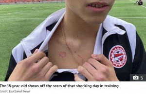 落雷によってできた傷（画像は『The Sun　2020年7月21日付「BOLT FROM THE BLUE Miracle teen goalkeeper shows off scars from being struck by LIGHTNING and is ready to play again just two weeks on」（Credit: East2west News）』のスクリーンショット）