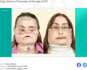 手術前と手術後のコニーさん（画像は『WKYC.com　2020年7月31日付「Doctors salute the life of Connie Culp, recipient of the first US face transplant at Cleveland Clinic」』のスクリーンショット）