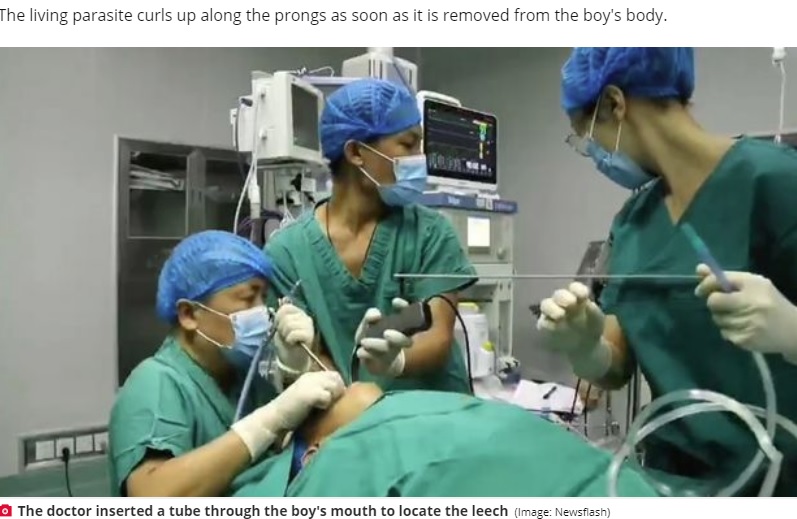 5歳男児のヒルの摘出手術の様子（画像は『Daily Star　2020年10月26日付「Huge leech pulled from young boy’s throat after it lived there for over a year」（Image: Newsflash）』のスクリーンショット）