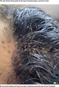 頭にびっしりついたシラミ（画像は『The Sun　2020年10月1日付「BUGS STRIFE Skin-crawling video shows THOUSANDS of head lice wriggling in woman’s hair」』のスクリーンショット）