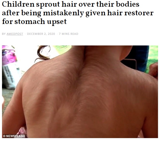 製薬会社の誤った薬を服用し多毛症に（画像は『The Amed Post　2020年12月2日付「Children sprout hair over their bodies after being mistakenly given hair restorer for stomach upset」（（C）NEWSFLASH）』のスクリーンショット）
