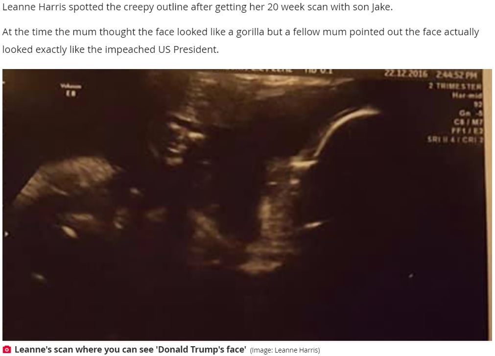 エコー写真にトランプ大統領の顔が？（画像は『Daily Record　2021年1月14日付「Mum’s shock at seeing ‘Donald Trump’s face’ in her baby scan picture」（Image: Leanne Harris）』のスクリーンショット）