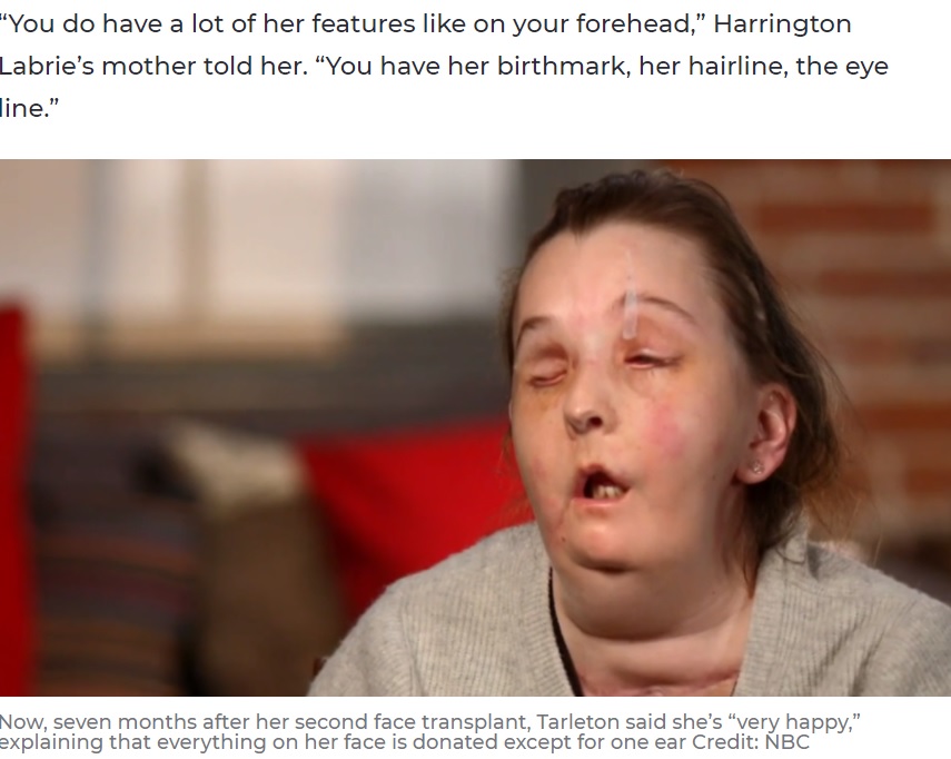 昨年7月に2度目の顔面移植手術を受けたカルメンさん（画像は『7NEWS.com.au　2021年2月28日付「Domestic abuse survivor becomes 1st person ever to undergo second face transplant」（Credit: NBC）』のスクリーンショット）