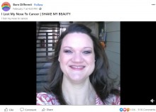 【海外発！Breaking News】がんで鼻を失った女性「義鼻は付けない。生きていることより美しいことはないから」（米）＜動画あり＞