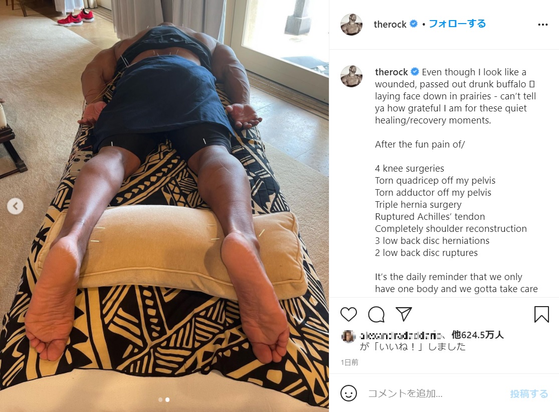 鍼灸針だらけのロック様（画像は『therock　2021年2月26日付Instagram「Even though I look like a wounded, passed out drunk buffalo laying face down in prairies」』のスクリーンショット）