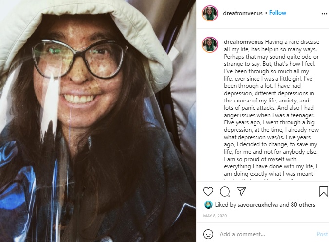 外出する時は皮膚を覆うアンドレアさん（画像は『Andrea Ivonne Monroy　2020年5月8日付Instagram「Having a rare disease all my life,」』のスクリーンショット）