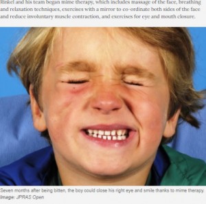 治療開始から7か月後、右目の開閉が可能に（画像は『TimesLIVE　2021年5月22日付「Eina! Four-year-old recovers after cobra bites his face during SA holiday」（Image: JPRAS Open）』のスクリーンショット）