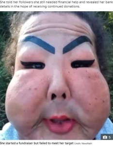 頬が腫れ上がり垂れ下がる（画像は『The Sun　2021年4月16日付「AN’T FACE IT Trans woman who injected industrial silicone into her face forced to live with droopy cheeks as she can’t afford ￡6k op」（Credit: Newsflash）』のスクリーンショット）