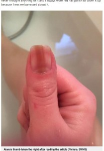 親指の爪にうっすらと現れた線は皮膚がんの症状の1つだった（画像は『Metro　2021年6月27日付「Woman discovers line on her fingernail was a rare sign of cancer」（Picture: SWNS）』のスクリーンショット）