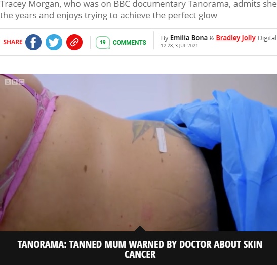 33個の不自然なほくろが確認されたトレイシーさん（画像は『Mirror　2021年7月3日付「Tan-shamed mum leaves doctor’s office in tears after devastating warning」（Image: BBC/Tanorama）』のスクリーンショット）