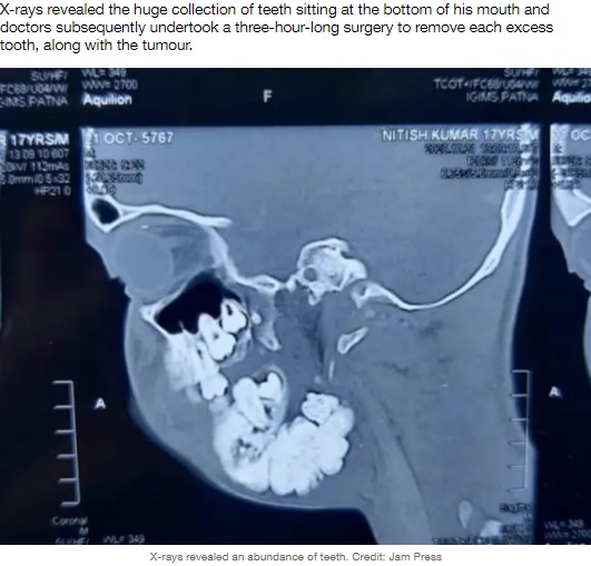 17歳少年のレントゲン写真（画像は『LADbible　2021年7月12日付「Teenager With Rare Tumour Has 82 Teeth Removed From Jaw In Three-Hour Operation」（Credit: Jam Press）』のスクリーンショット）