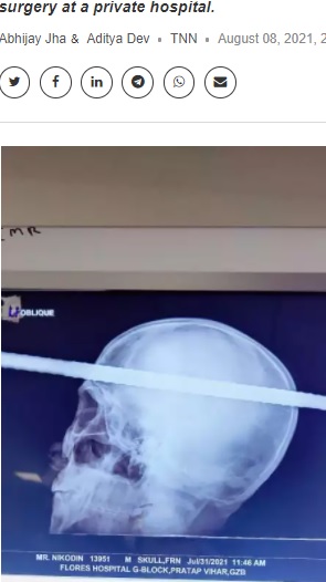 頭蓋骨を貫通した鉄の棒（画像は『The Economic Times　2021年8月8日付「Ghaziabad: Rod that pierced man’s skull removed after 4-hour surgery」』のスクリーンショット）