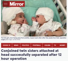 【海外発！Breaking News】頭部が結合した双子姉妹、分離手術が成功し初めてお互いの顔を見つめ合う（イスラエル）＜動画あり＞