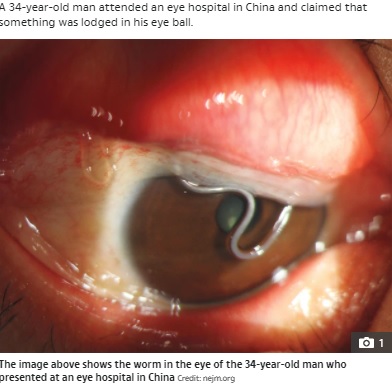 目の中を蠢く寄生虫（画像は『The Sun　2021年9月20日付「EYE SORE Video reveals moment docs discover horrifying truth about ‘foreign body’ lodged in man’s eyeball」（Credit: nejm.org）』のスクリーンショット）