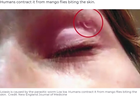 女性の左瞼に現れた糸状の塊（画像は『7NEWS　2021年9月3日付「Traveller’s horrifying find in EYE LID after returning from trip overseas」（Credit: New England Journal of Medicine）』のスクリーンショット）