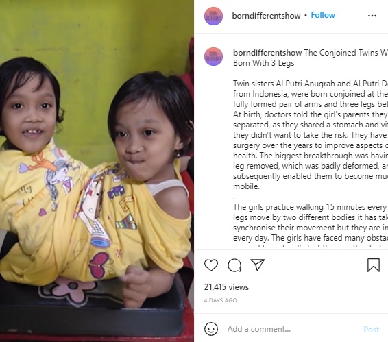 台車を改良した特別な椅子に座る2人（画像は『Born Different　2021年9月28日付Instagram「The Conjoined Twins Who Were Born With 3 Legs」』のスクリーンショット）