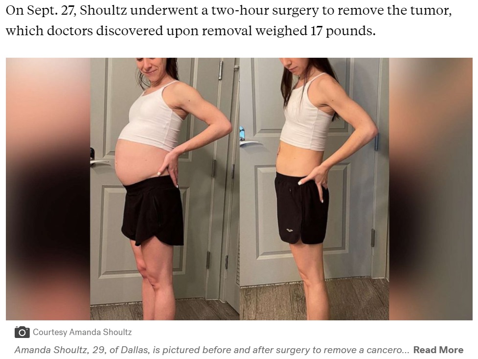 手術前と手術後の女性（画像は『ABC News　2021年10月14日付「Woman who struggled for months with weight gain diagnosed with 17-pound cancerous tumor」（Courtesy Amanda Shoultz）』のスクリーンショット）